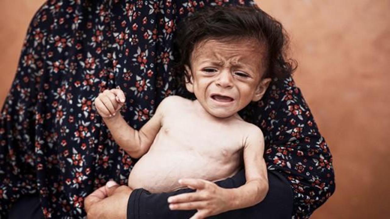 5 aylık Ammar açlıktan ölmek üzere