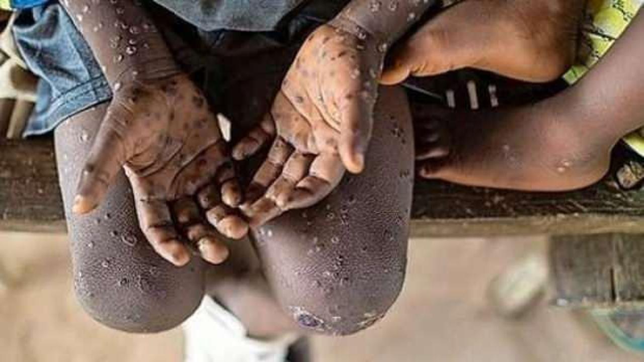 Afrika kıtası, M çiçeği salgınıyla karşı karşıya