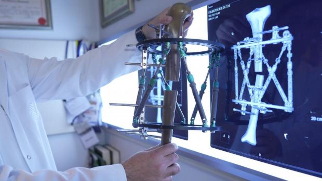 Boy kısalığında çığır açan tedavi: Günde 1 milimetre uzatan yöntem