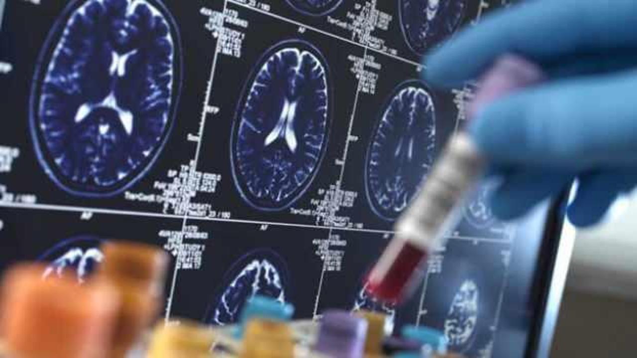 Bu kan testi her şeyi değiştirecek: Alzheimer artık erken evrede tespit edilebiliyor!