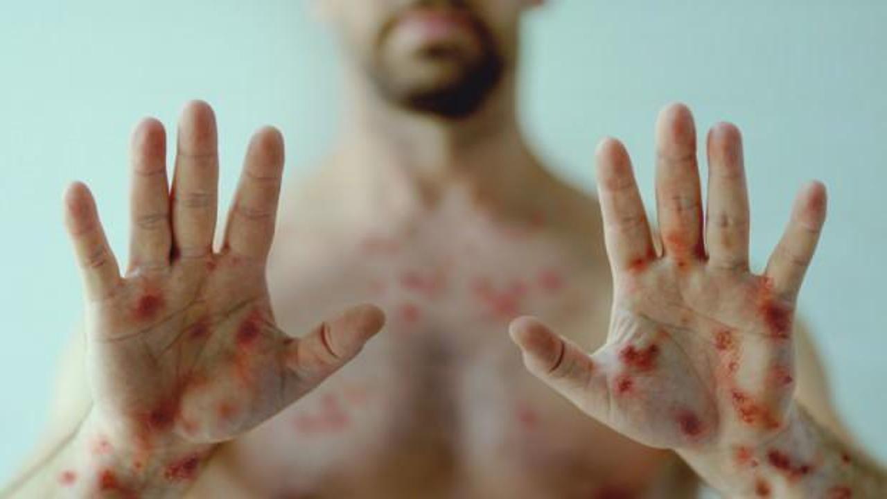 DSÖ'den Maymun Çiçeği açıklaması: Yeni Covid değil