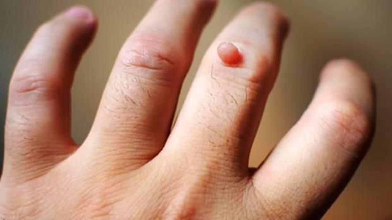 Evde doğal siğil tedavisi! Elde siğil neden çıkar, nasıl geçer?