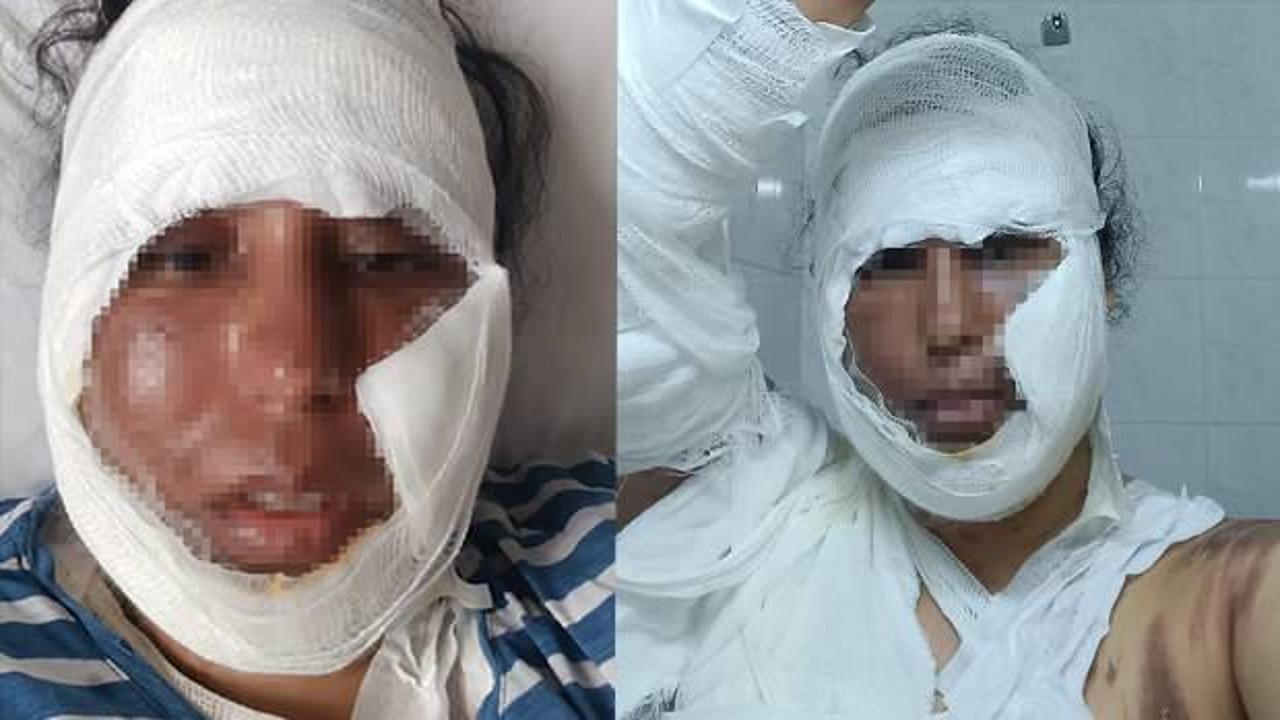 Görümcesi dehşeti yaşattı: Yüzüne kaynar su fırlattı!